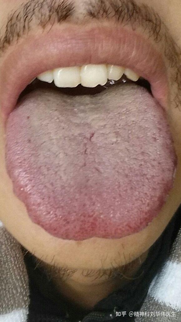 心肾不交的舌苔图片图片