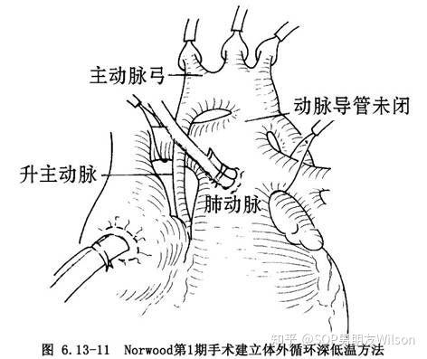 【wilson的医学杂谈】左心发育不良,norwood术式,fontan手术经典应用