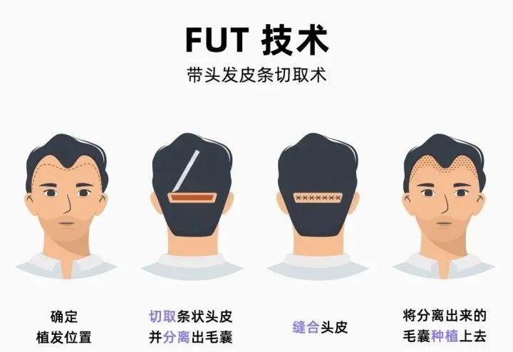 乙肝哪里可以植发(乙肝植发医院会不会检查错)