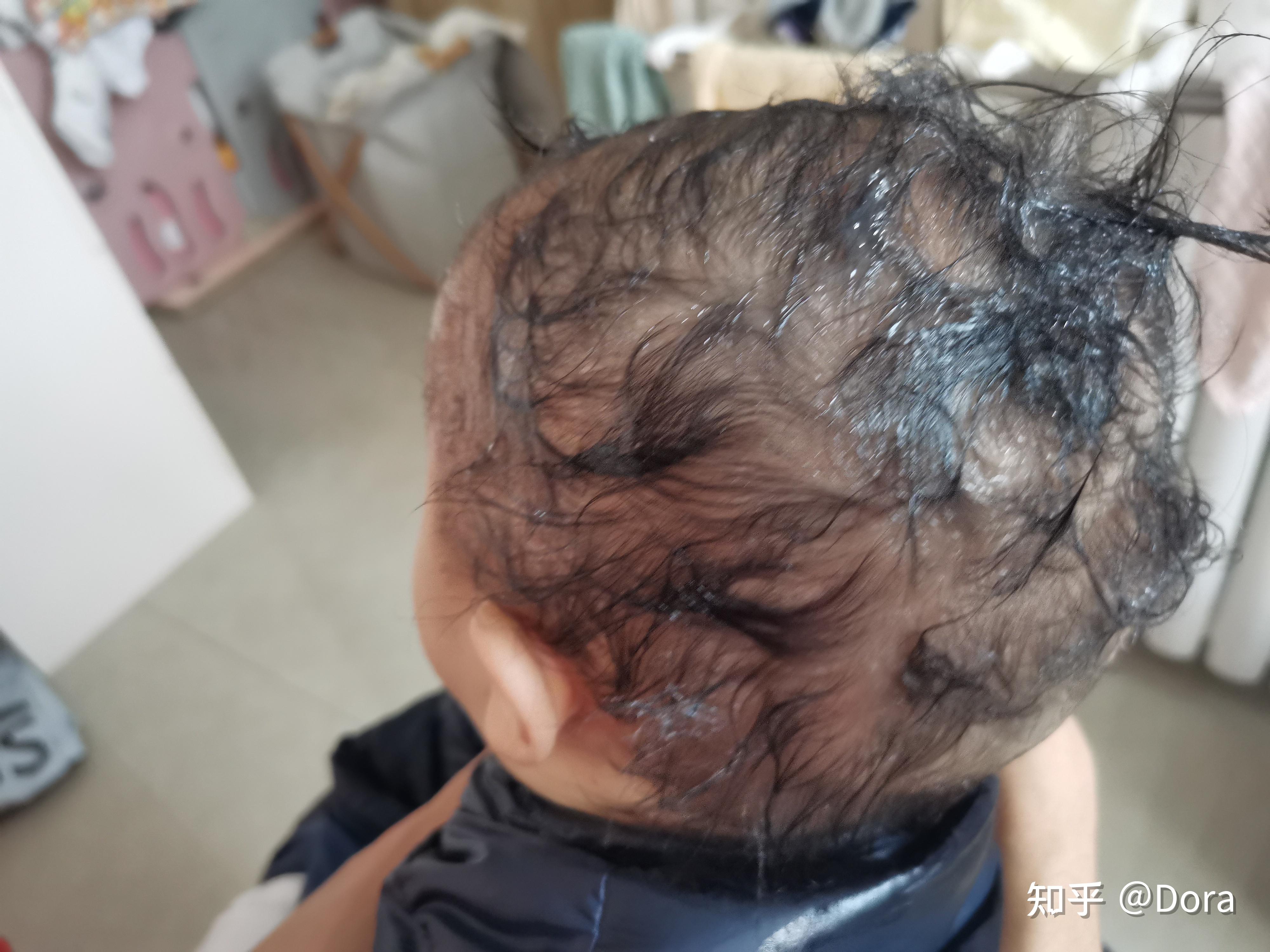 新生儿有头垢怎么办有哪些比较好的处理方式