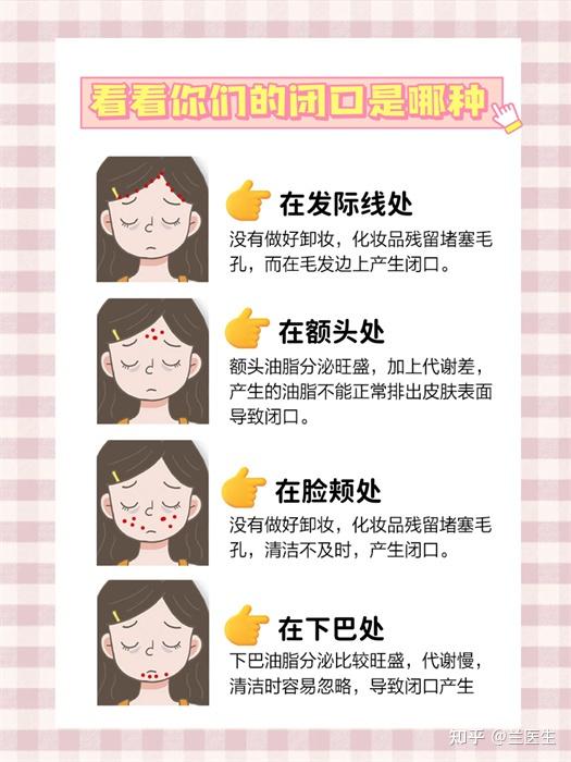 痤疮,痘痘,闭口,粉刺,白头有什么区别? - 知乎
