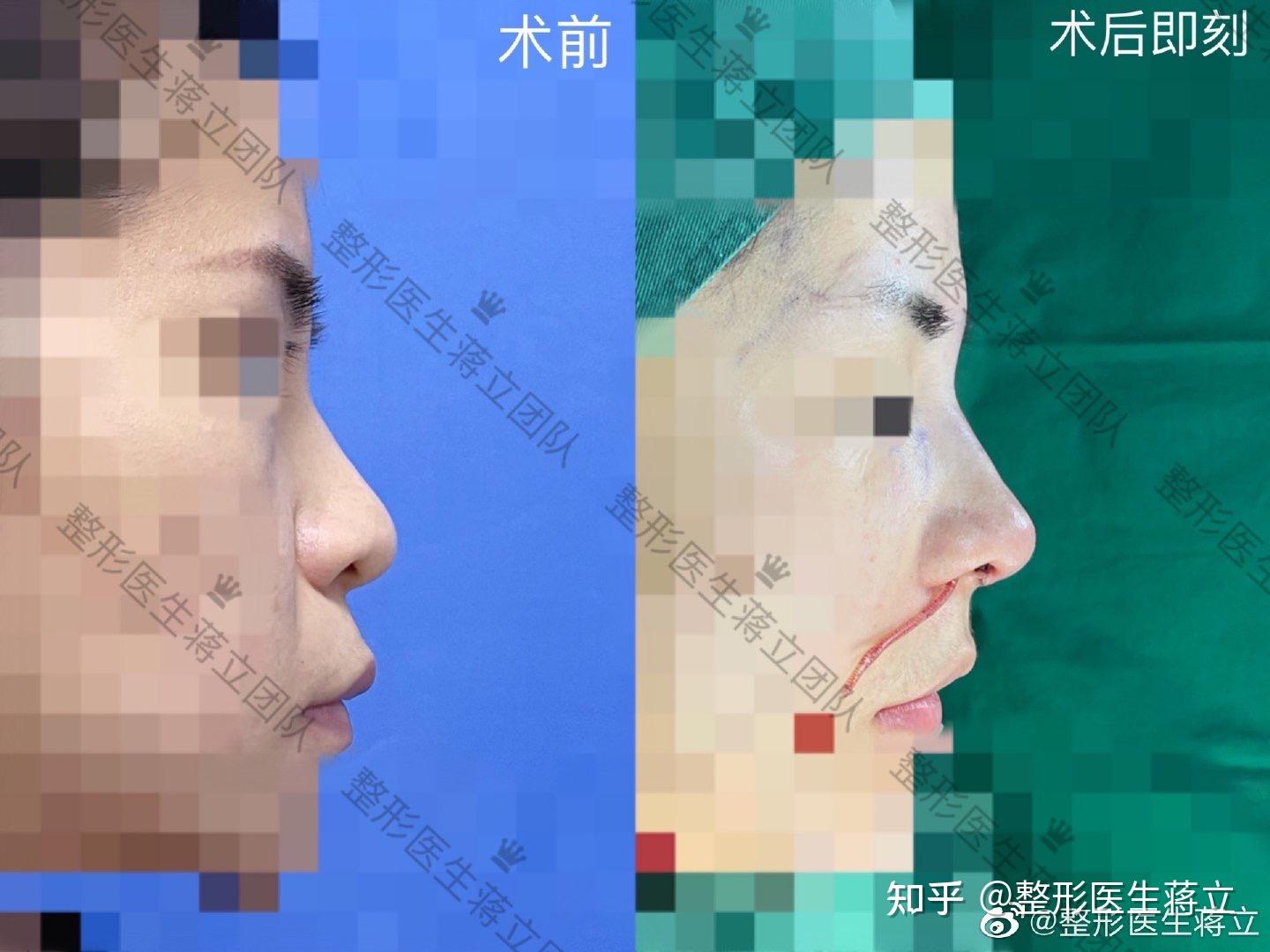中面部、鼻基底凹陷,鼻头圆钝缺少表现点,鼻骨宽,鼻翼缘退缩,塌鼻,鼻翼高低不齐。 - 知乎