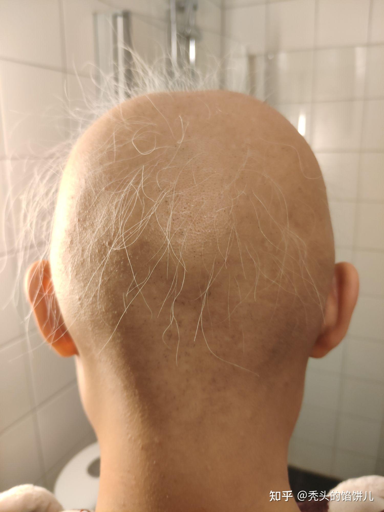 斑秃全秃复发后的最新更新