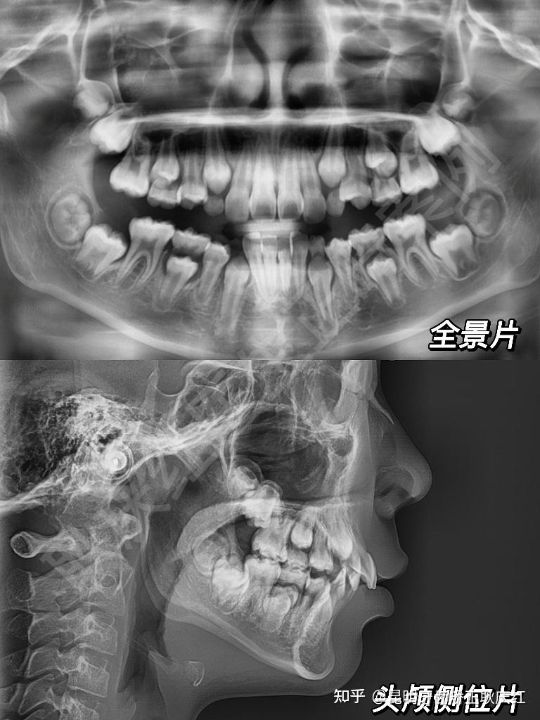 昆明牙齿矫正 |深覆合隐适美矫正——全景片,头颅侧位片分析 - 知乎