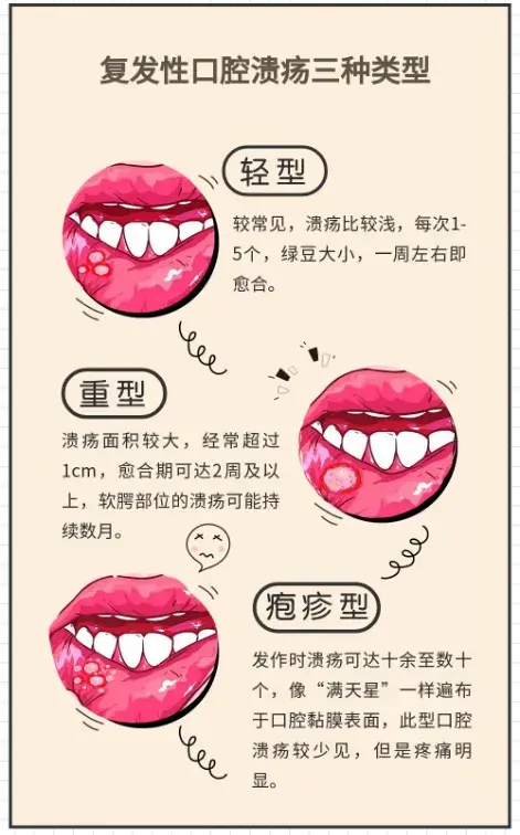 口腔溃疡反复折磨,究竟该如何应对! - 知乎