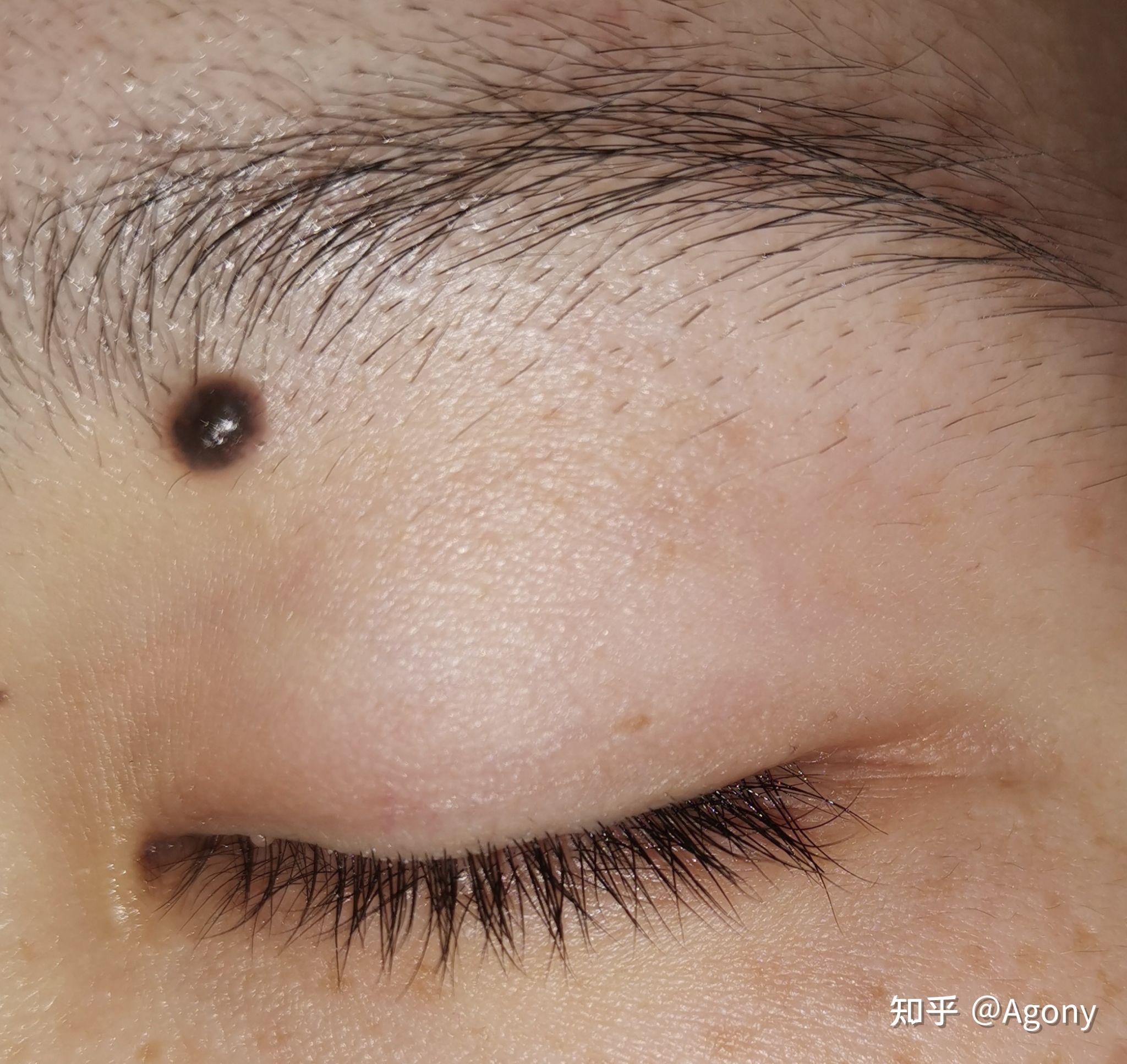 手术去痣 - 知乎