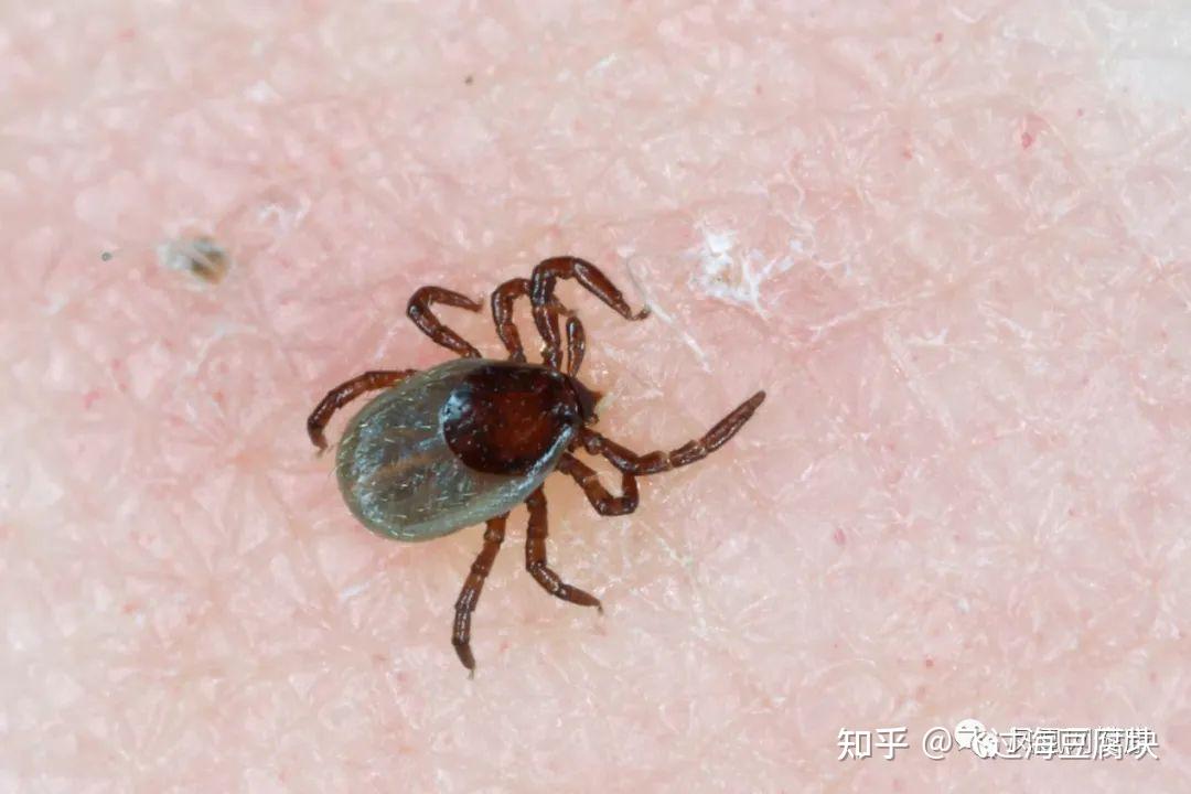 夏天要注意这种虫子咬的时候不痛不痒但是很危险