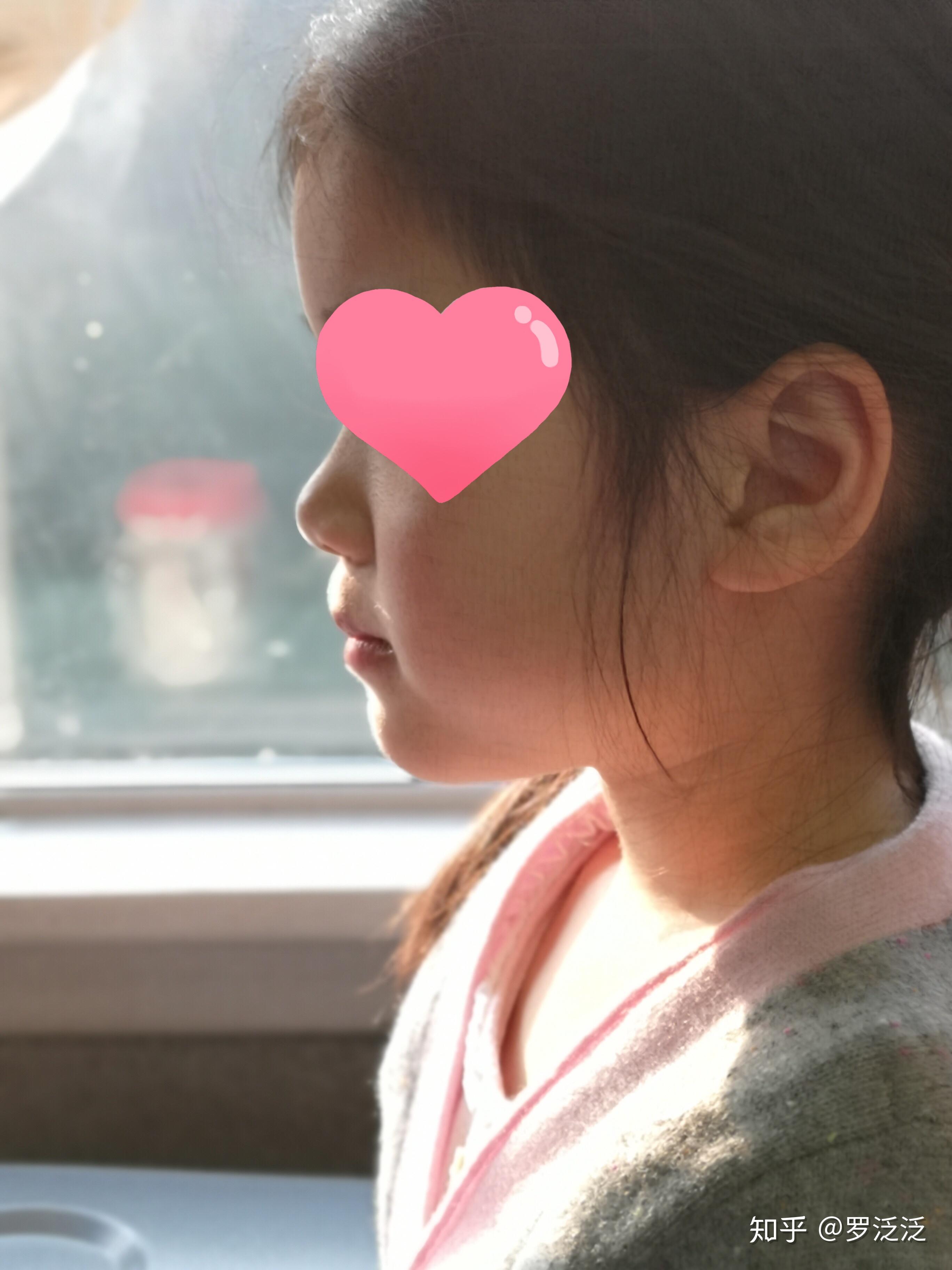 幼儿地包天什么时候矫正较好