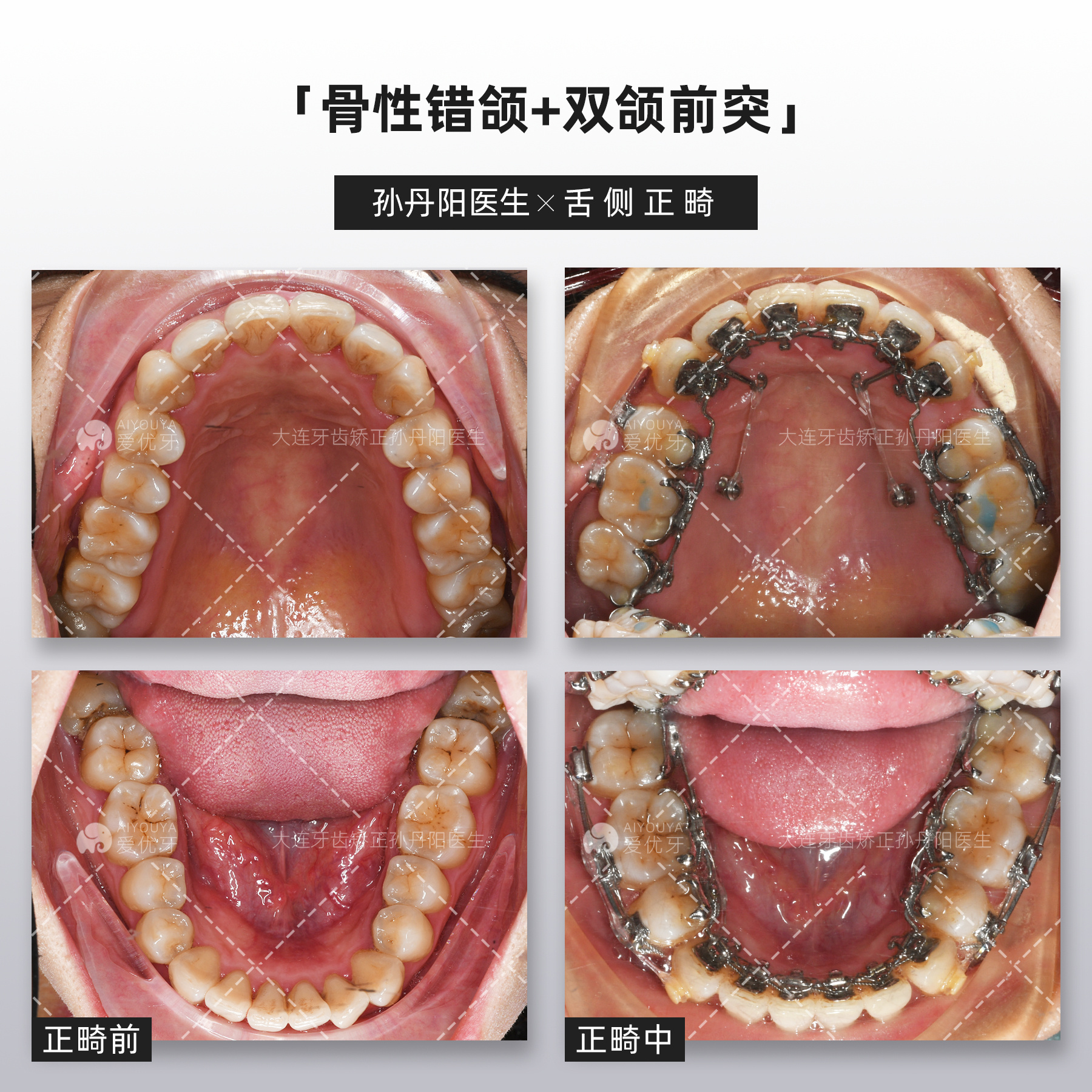 骨性嘴凸正畸图片