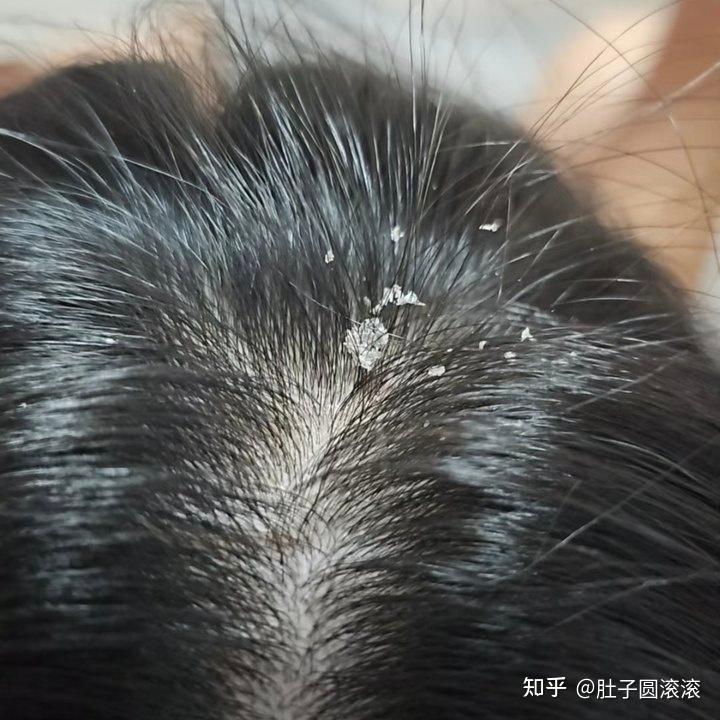 头上有很多大块的头皮屑，该怎么办？