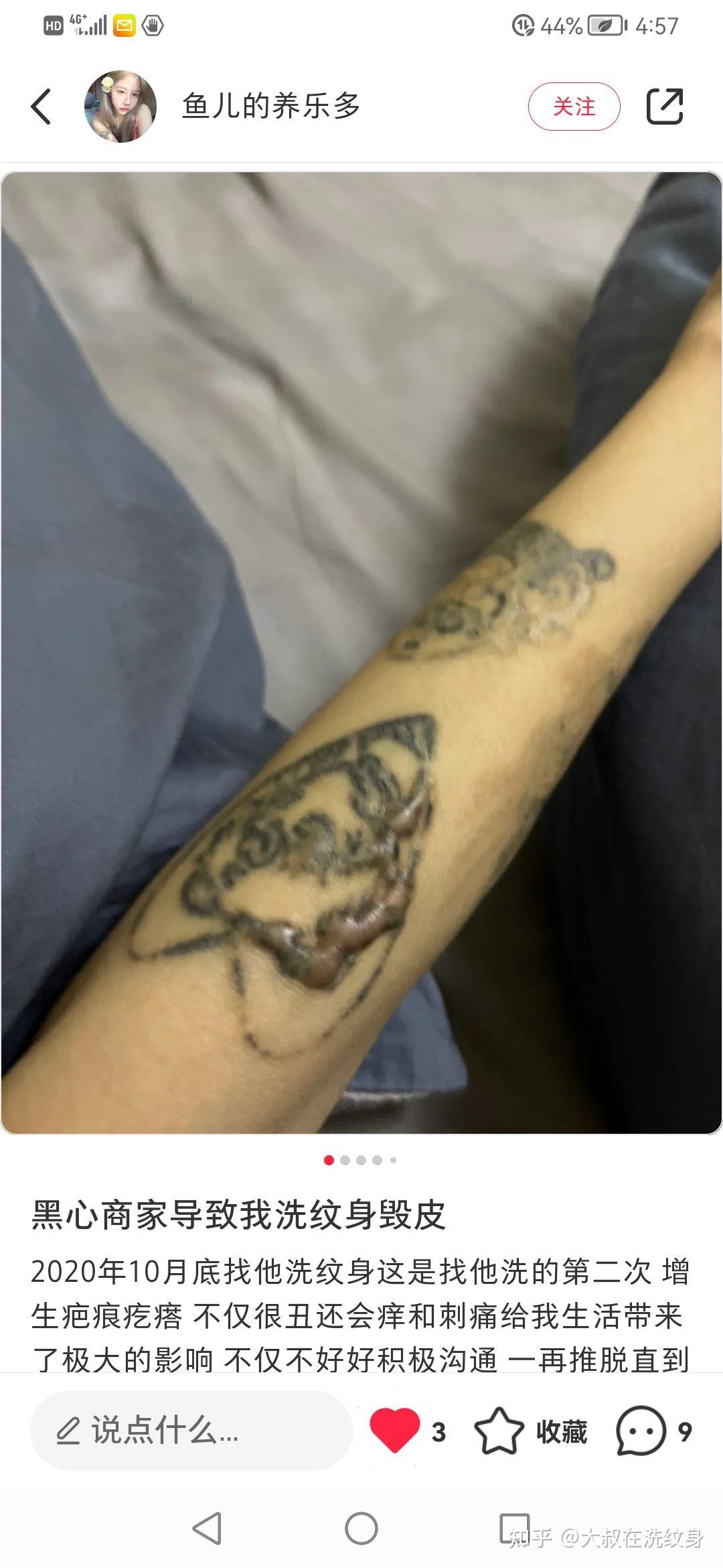 洗纹身怎么收费的啊是去医院皮肤科还是纹身店