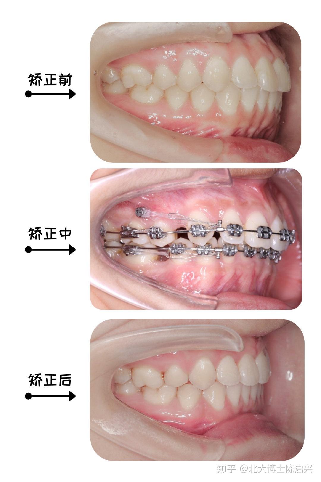 矫正牙齿(正畸)打支抗钉是怎样的体验?