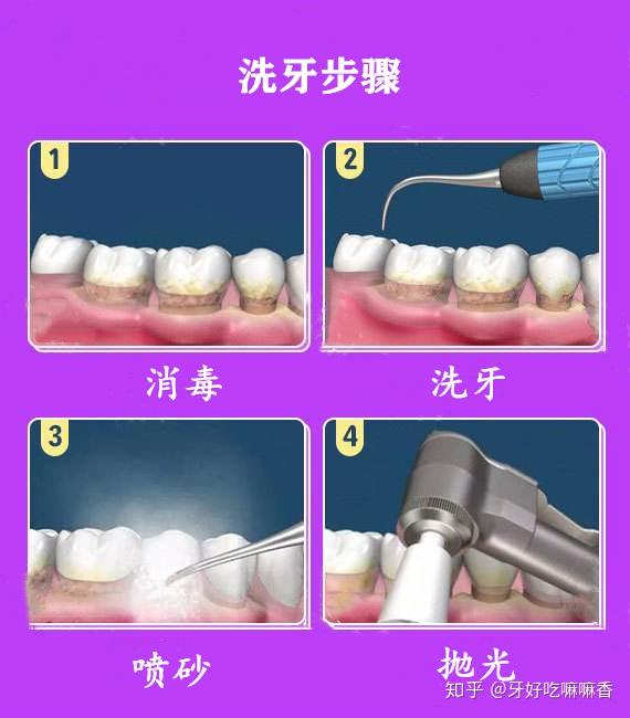 科普：洗牙的最全步骤！ 知乎 