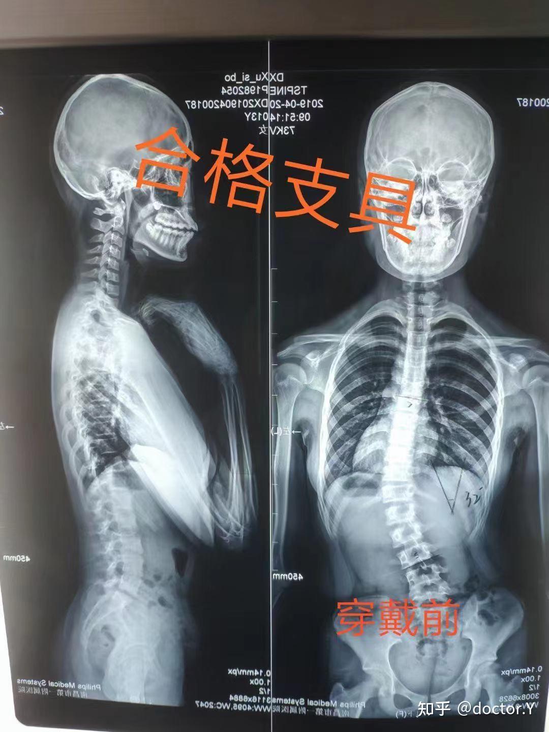 【脊柱侧弯康复】10岁女孩半年治疗后，脊柱回直！摆脱脊柱侧弯！ - 知乎