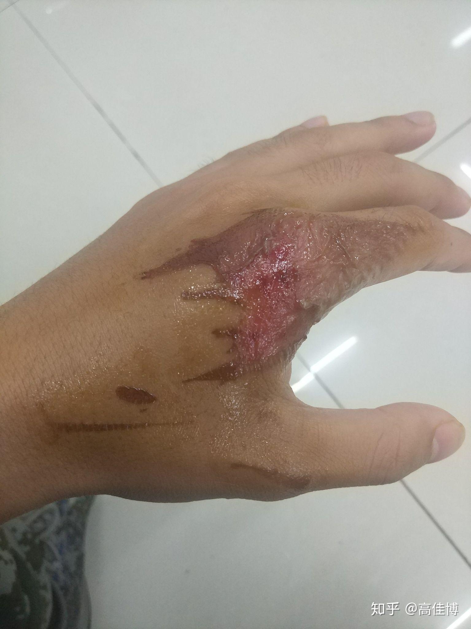 手被开水烫伤了怎么办