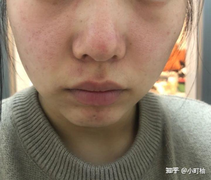 鼻头上的皮肤像鸡皮是为何(鼻头上的皮肤像鸡皮是为何呢)