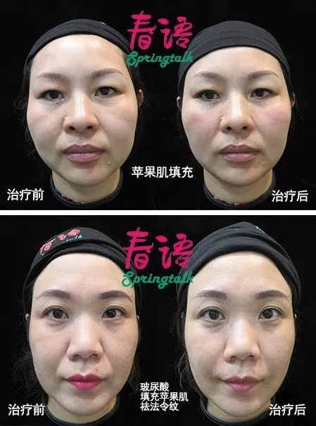 女生苹果肌下垂怎么办周围好多女生上了大四苹果肌就下垂了