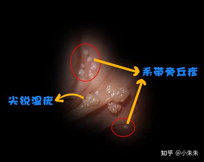 区分系带旁丘疹与尖锐湿疣需要什么要点?