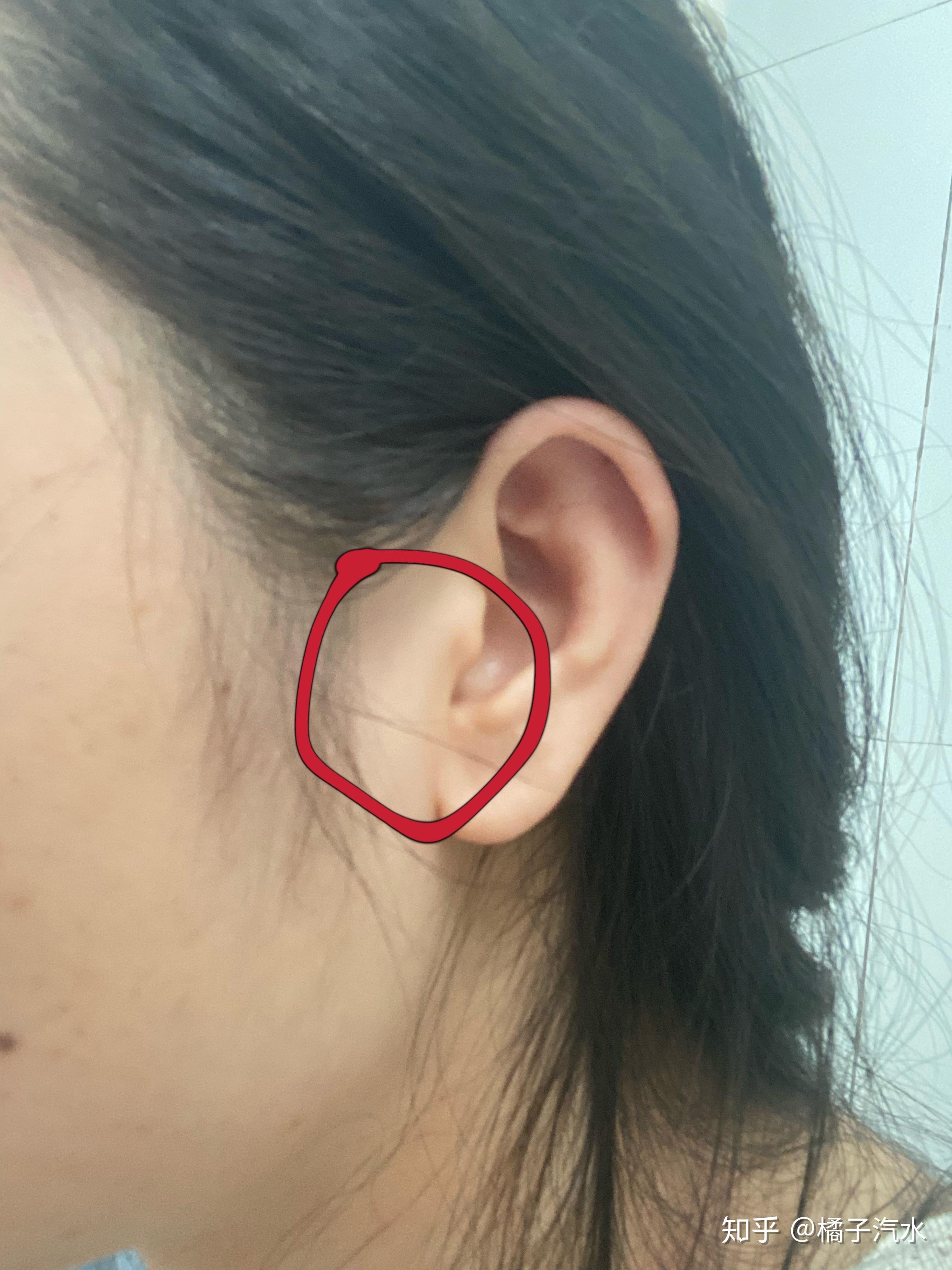 耳朵靠近脸颊那边有个硬块一觉睡醒就痛痛的摸一下发现是个硬块是突然