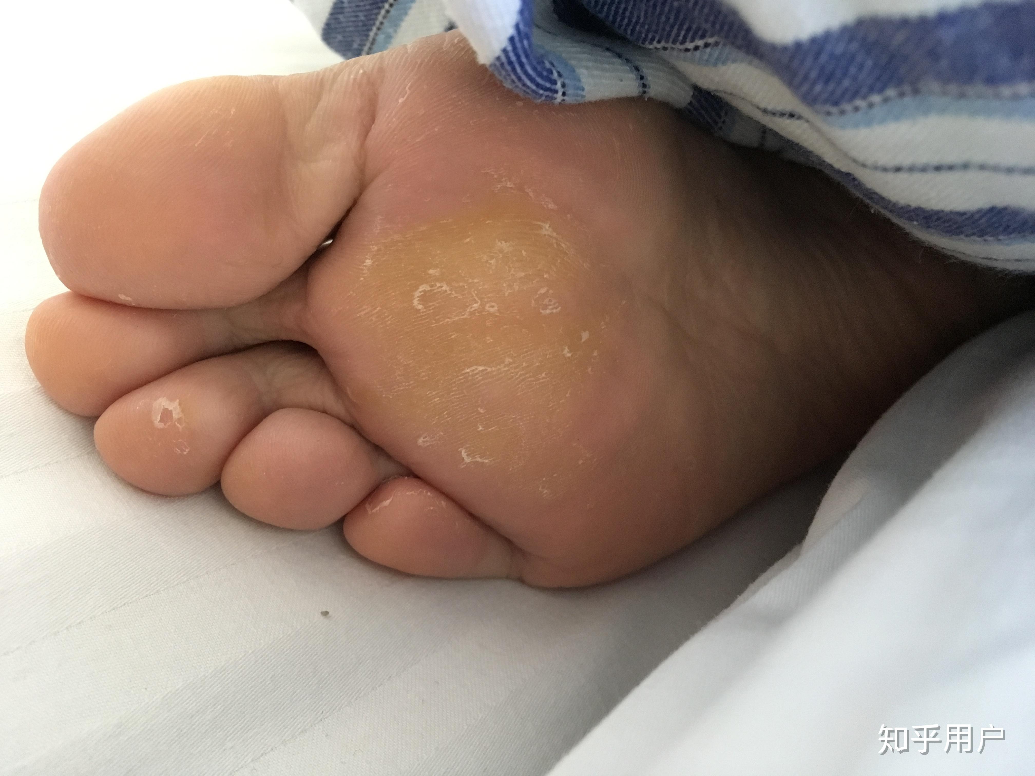 穿高跟鞋脚掌有厚茧该怎么办? - 知乎