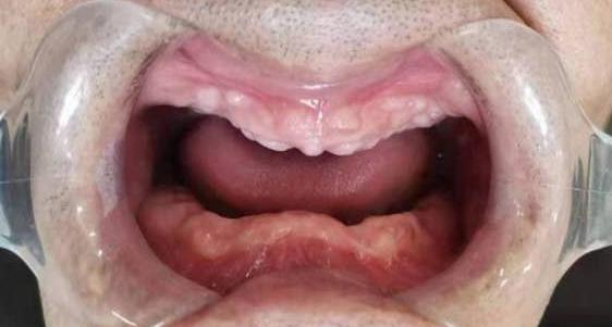 牙齿缺失很多缺几颗就要种几颗吗不一定