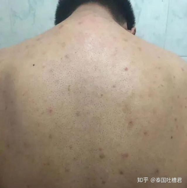 错过多年平价后背痘杀手泰国蛇牌爽身粉