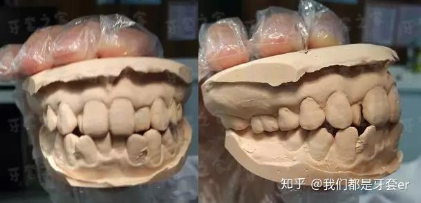 有正畸垫高后牙的吗