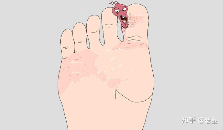 雨天拖鞋一时爽脚气来了怎么挡