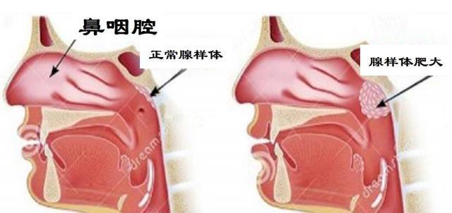 鼻咽癌的早期症状与就诊建议 - 知乎