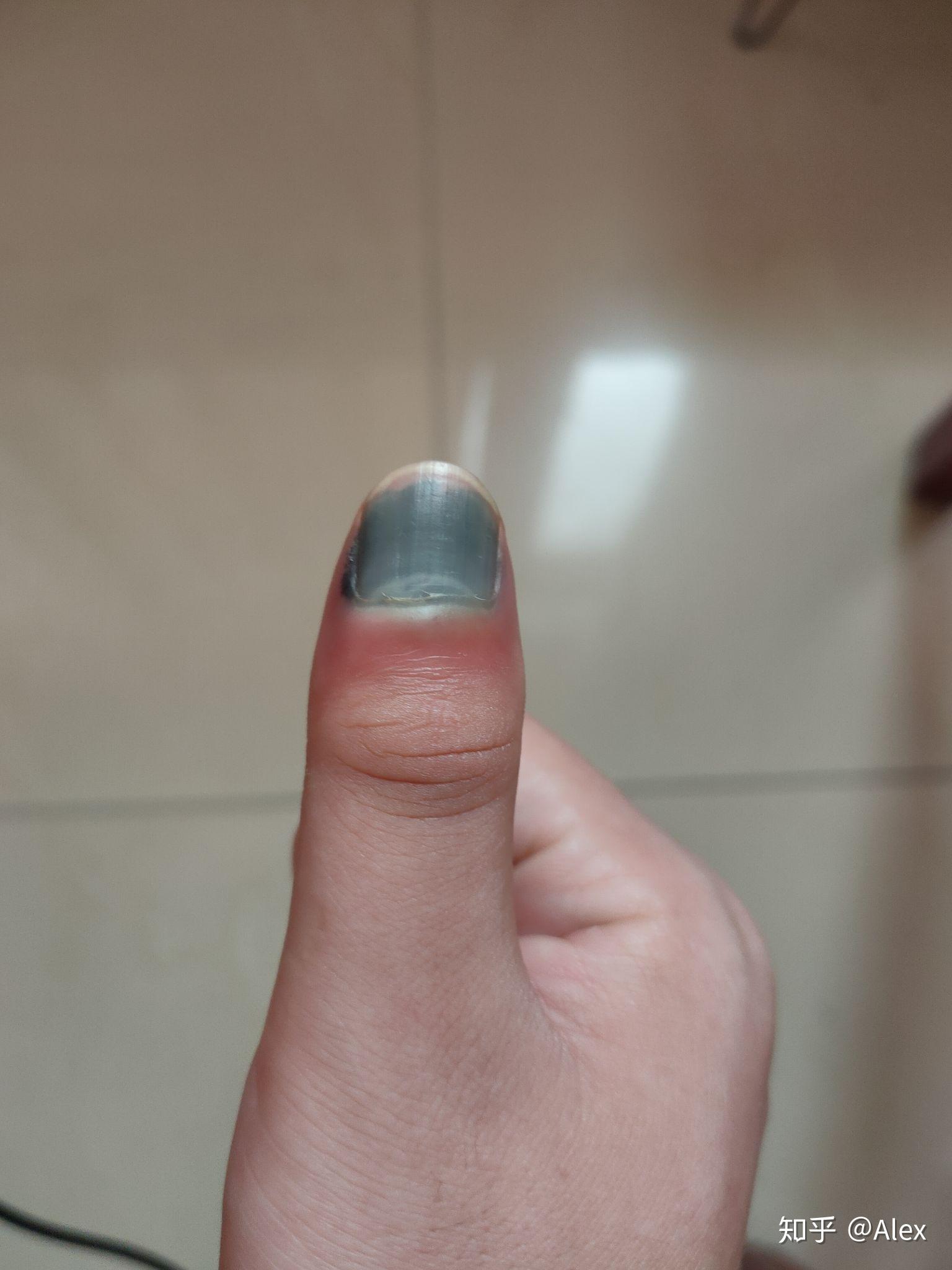 手指甲被夹到过了一段时间有黑色的淤血怎么处理