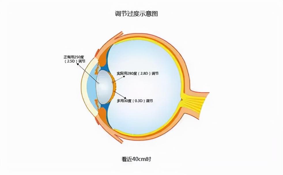 睫狀肌,它位於眼睛內部呈環形的平滑肌,作用於晶狀體,通過收縮和舒張