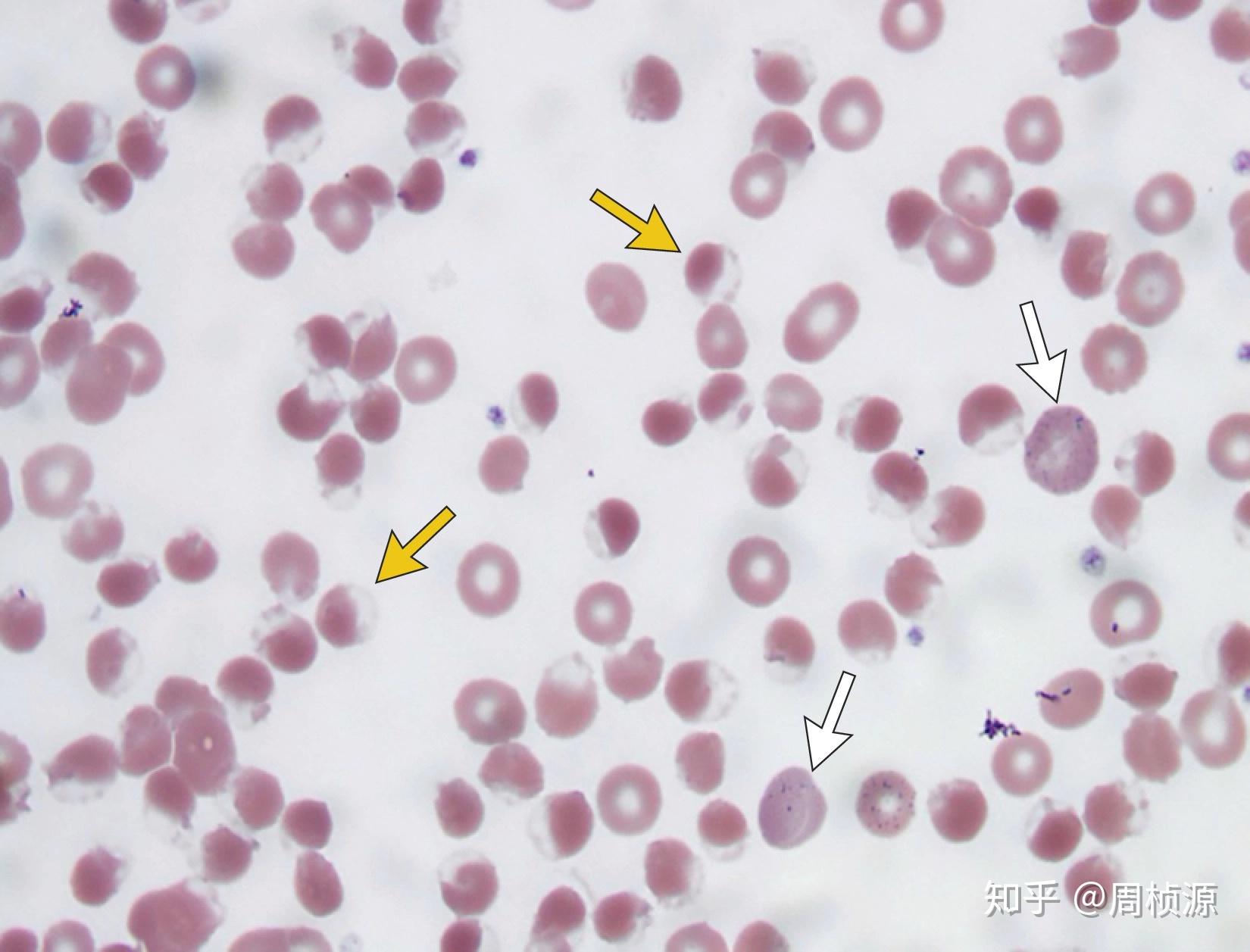外周血涂片(图3)见大量的咬痕细胞,是红细胞内氧化血红蛋白沉淀后