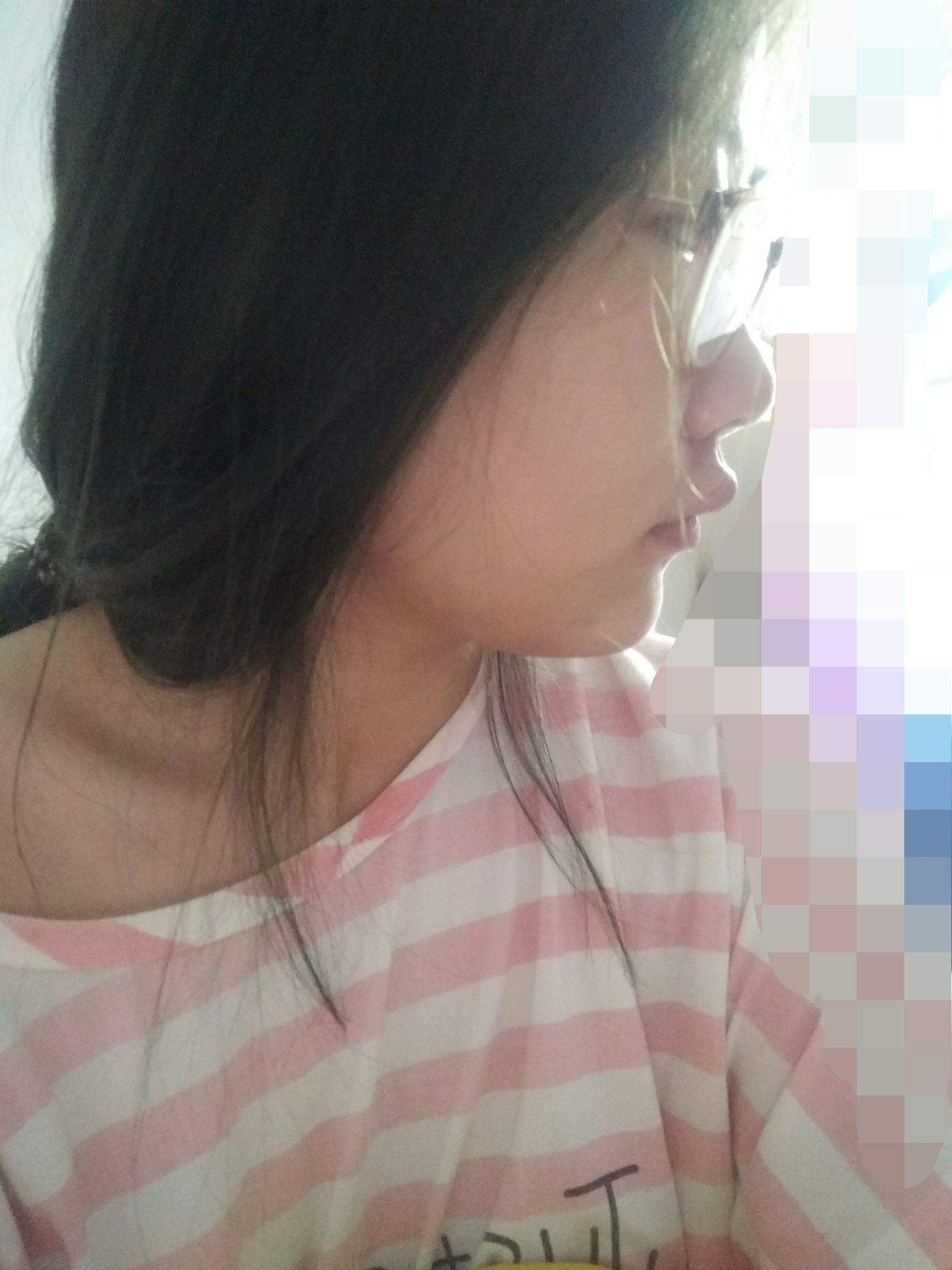 上嘴唇上翘上翻怎么办侧面看起来简直丑哭我