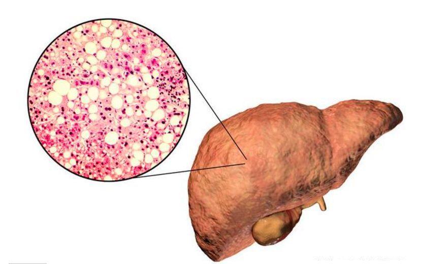 脂肪肝的症状和分类 你知道吗 知乎