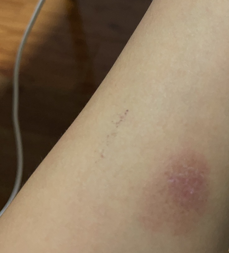 结核皮试起了个大水泡,破了怎么办? - 知乎