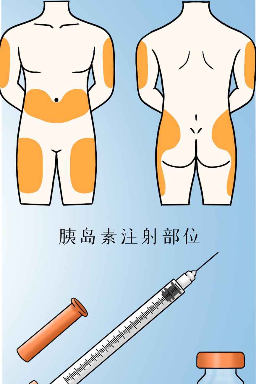 青少年得了糖尿病打胰岛素会一直长胖吗胰岛素是不是有发胖作用