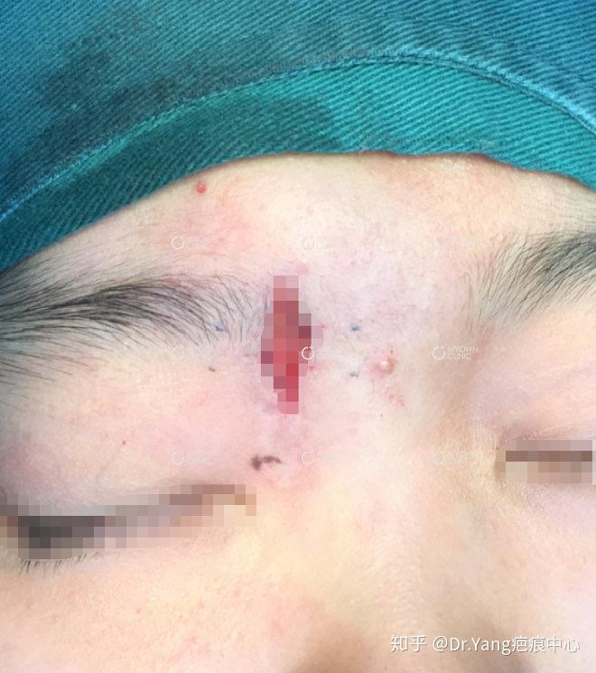 内眼角至眉头凹陷疤痕修复案例