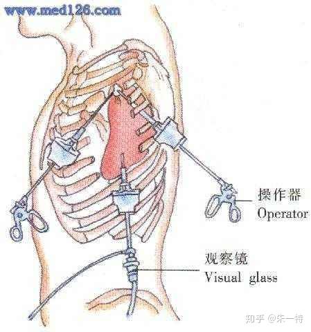 胸腔积液穿刺部位图片