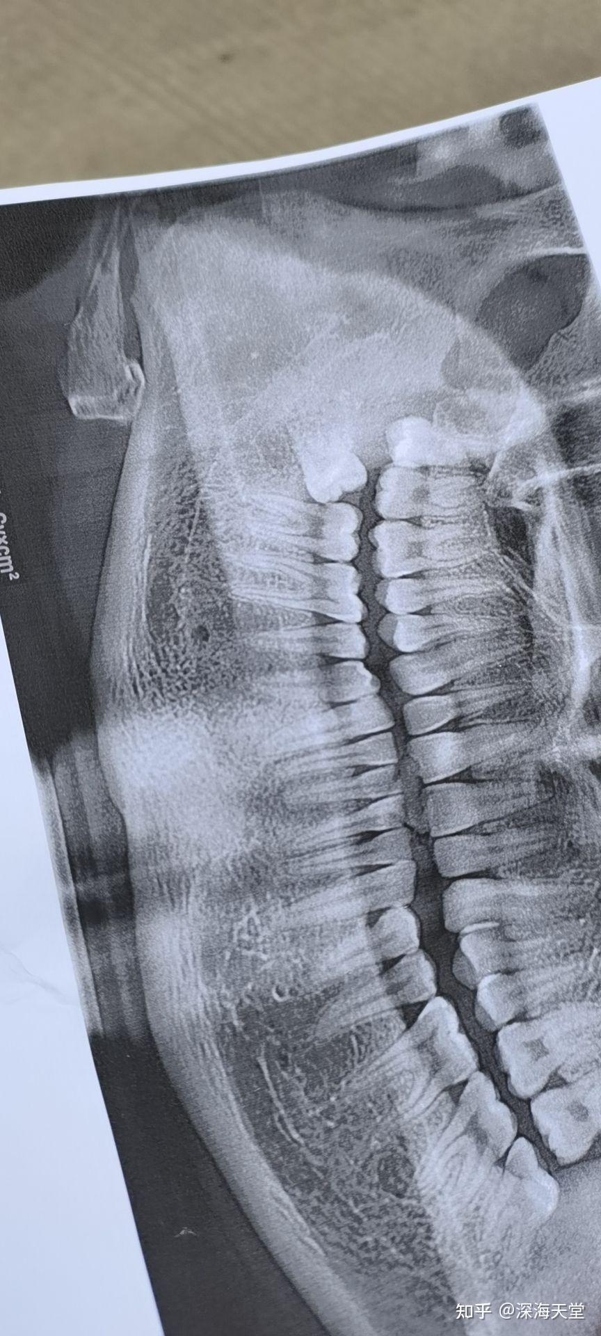 拔牙前必须要拍片子花了140元.