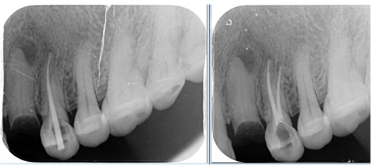 根管治疗是先抽牙神经还是先"磨牙"? - 知乎