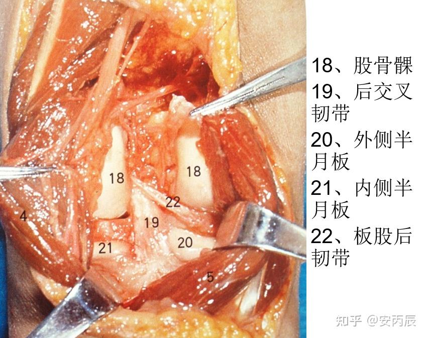 腘窝囊肿手术图谱图片