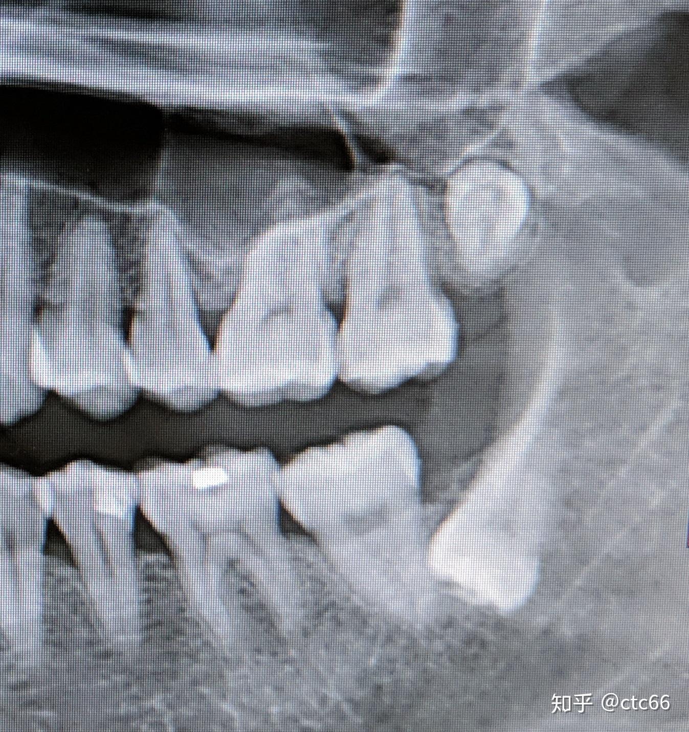 亲爱的智齿我不得不拔掉你
