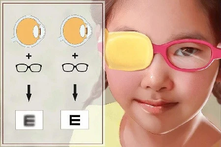 复视常见的治疗方法有哪几种 - 知乎