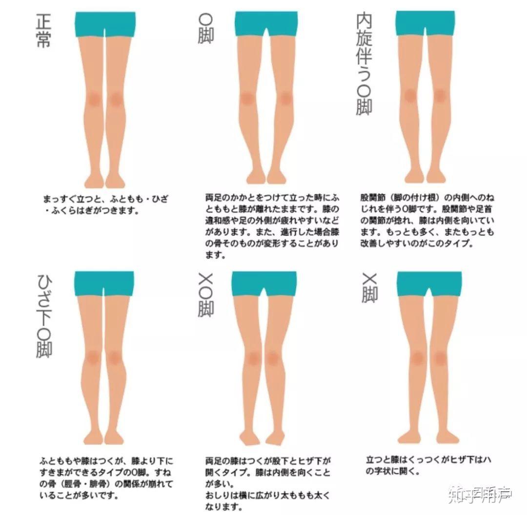 笔直大长腿 | XO腿追本溯源&对症下药篇足内翻足外翻 - 知乎