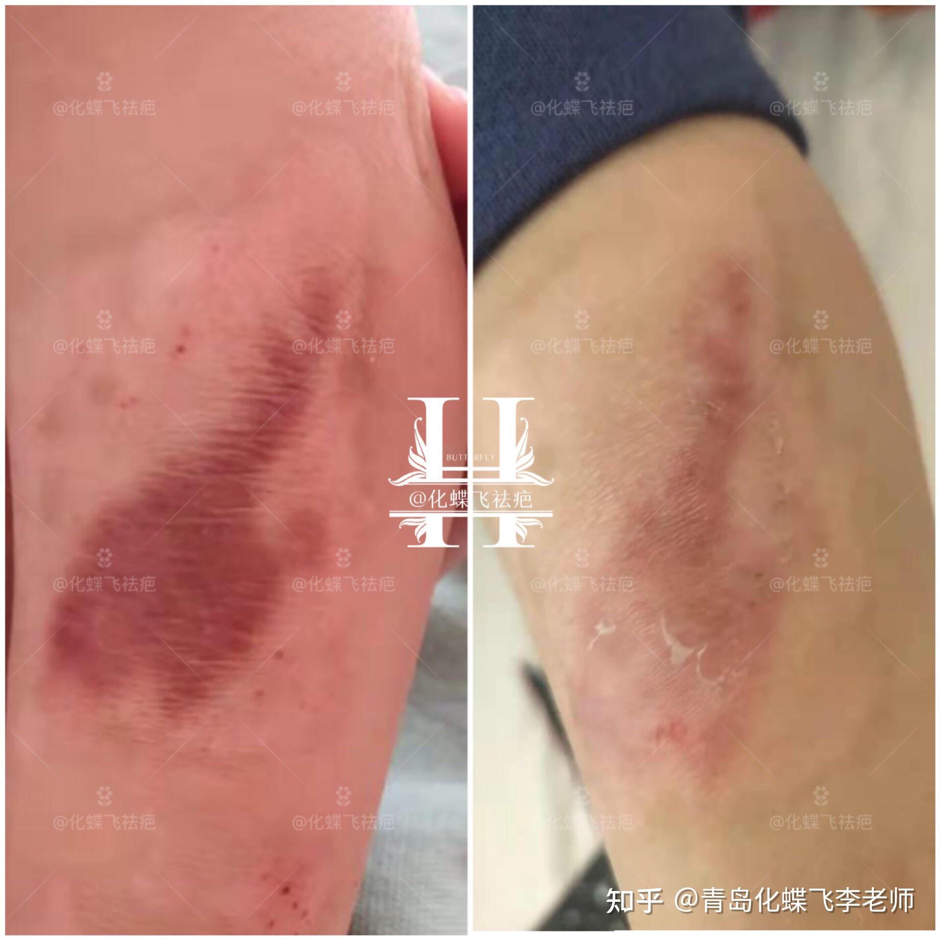 宝宝烫伤增生疤痕修复效果对比