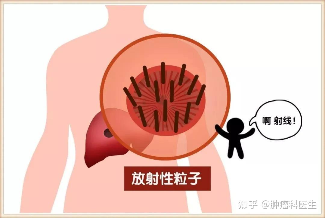 消融术配合经皮植入碘125粒子植入术:碘125粒子近距离肿瘤内部照射