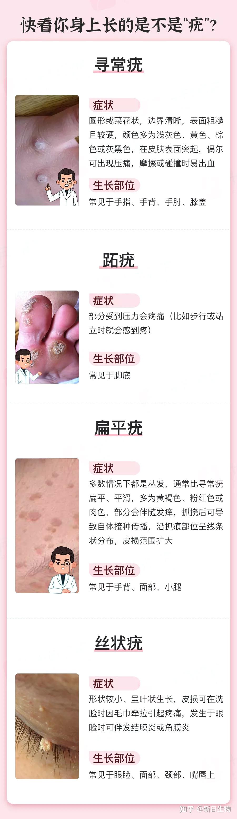 一张图教你辨别疣!常见的皮肤疣有哪些? - 知乎