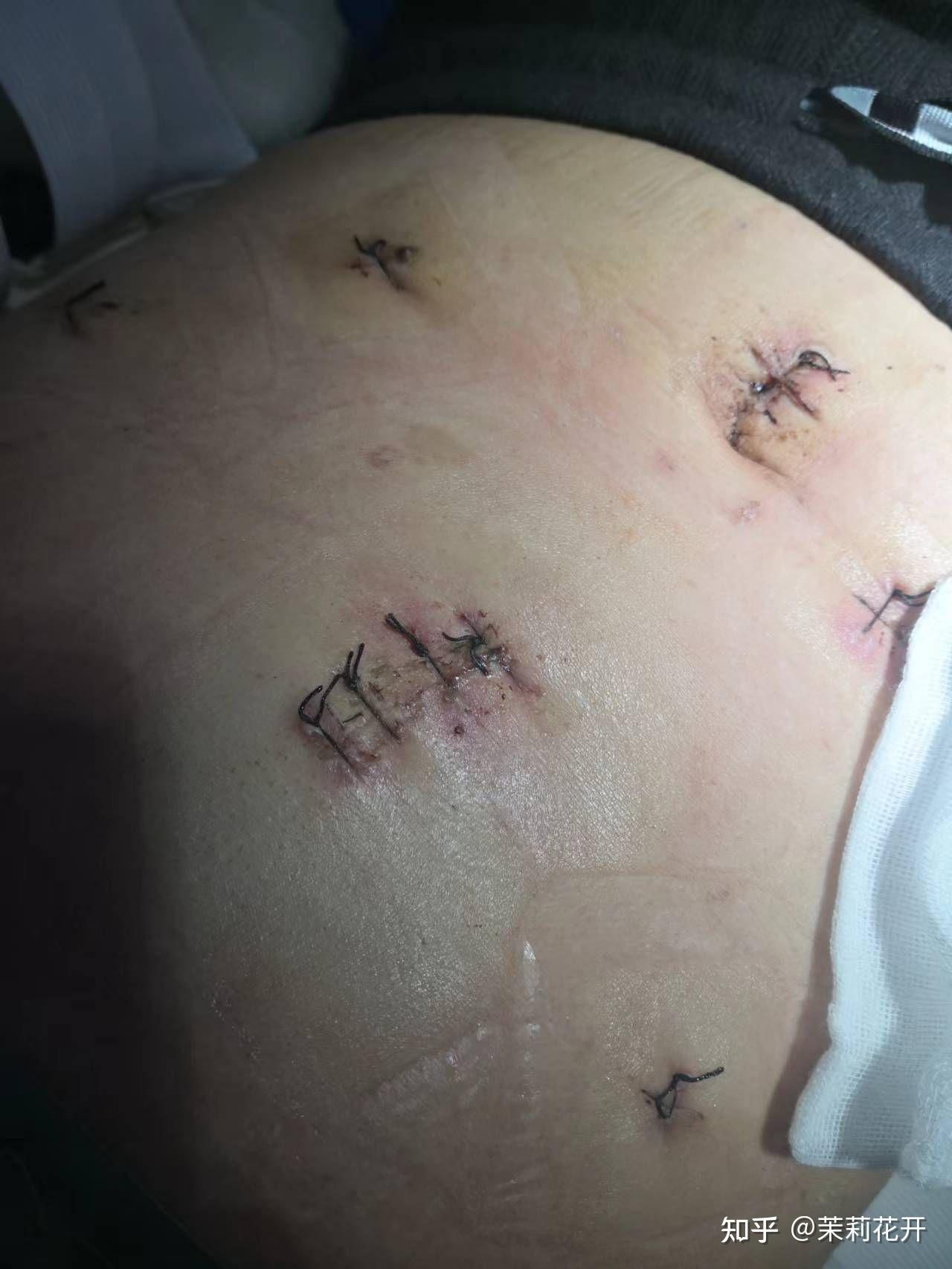 胰腺神经内分泌肿瘤手术过程 - 知乎