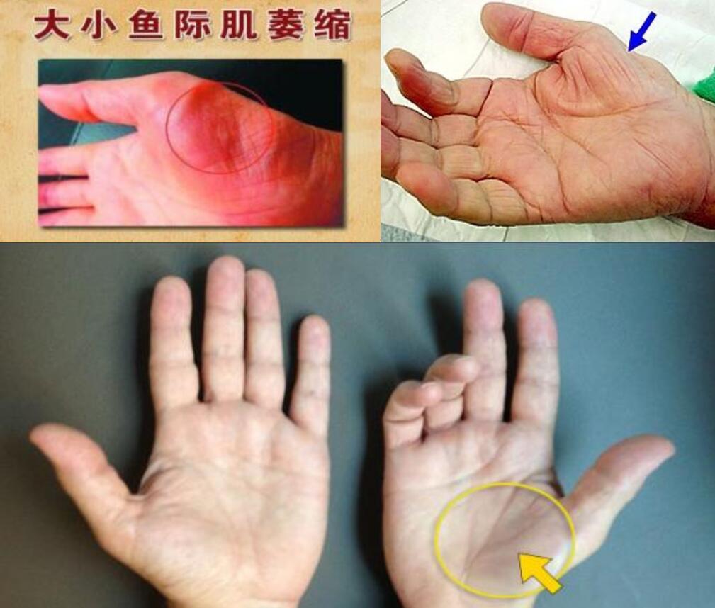 手引起的疼痛和麻木区域病程久者(晚期)——可见手掌鱼际肌群萎缩