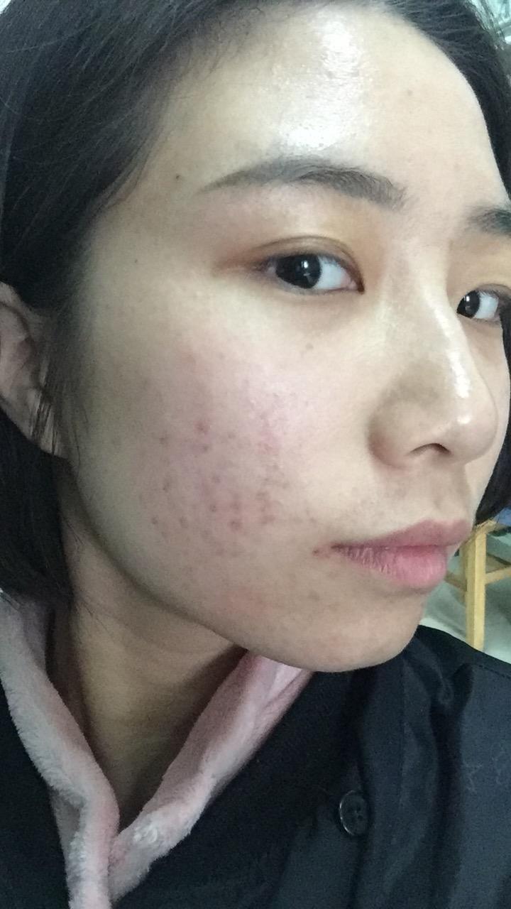 17岁女生因为脸上的痘坑对生活失去了信心